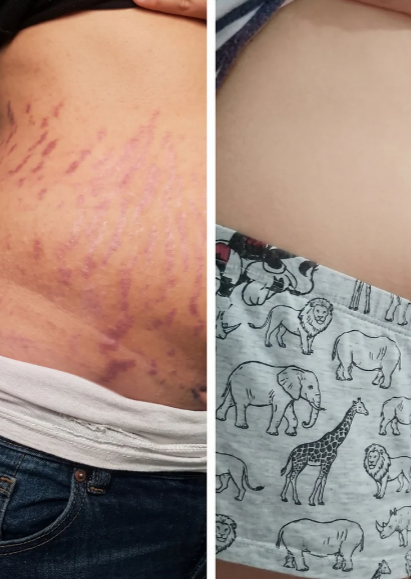 Antes e Depois Estrias 2